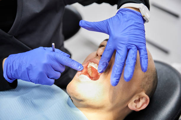 Best Emergency Dental Care for Abscessed Tooth in University Of Lifornia Santa Barbara, CA