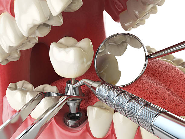 Best Emergency Dental Extractions in University Of Lifornia Santa Barbara, CA
